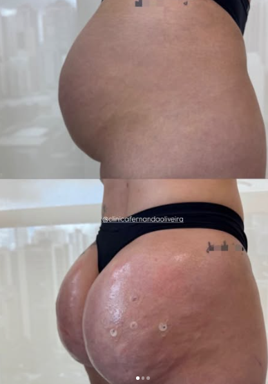 Bioestimulador de Glúteos