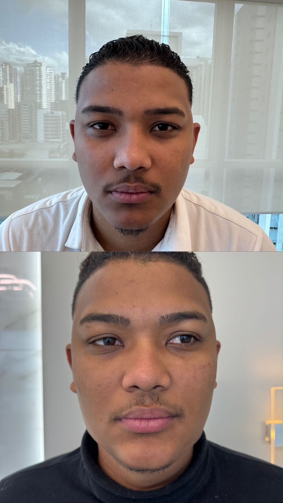 Harmonização Facial