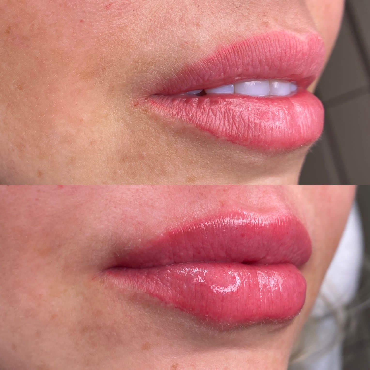 Preenchimento Labial